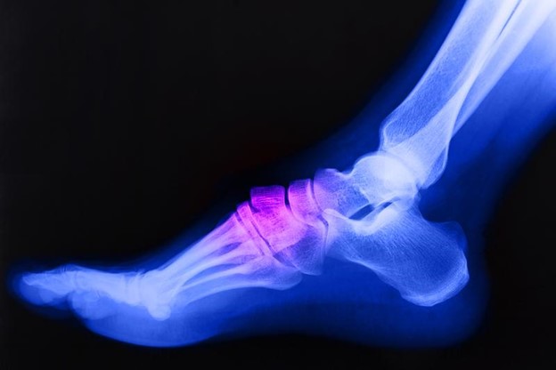 Foot x-ray