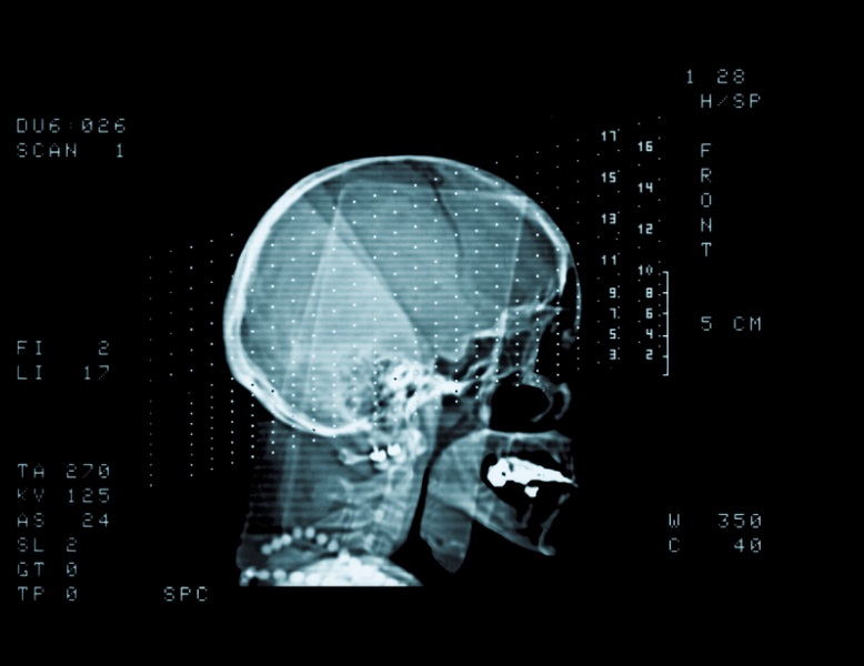X-ray of a human head.